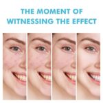 MOOYAM Salicylic Acid (Acne Removal Gel) - Image 2